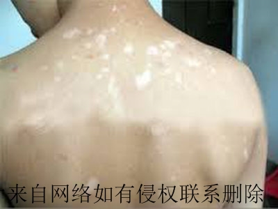 白癜风有哪些治疗重点呢