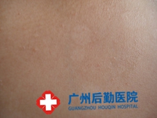 白癜风患者怎样解决心理问题