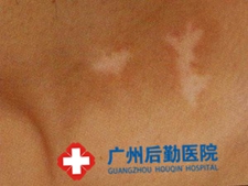 如何减少白癜风的危害